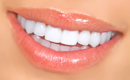 Can I Get Veneers