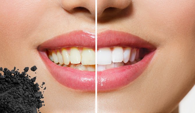 Charcoal Whitening Work