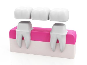 dental bridge illustration