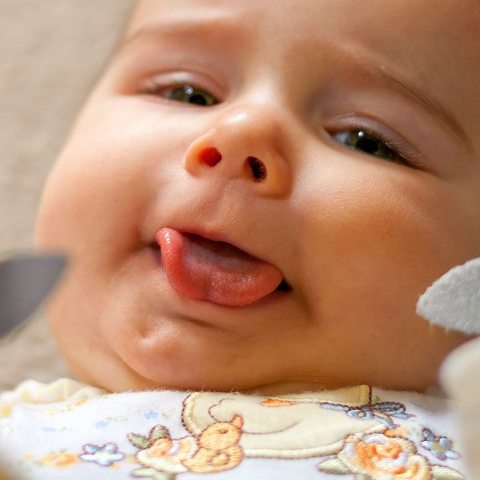 Lip And Tongue Ties A Guide For Parents