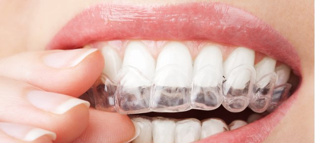 Straighten Your Teeth Without Braces