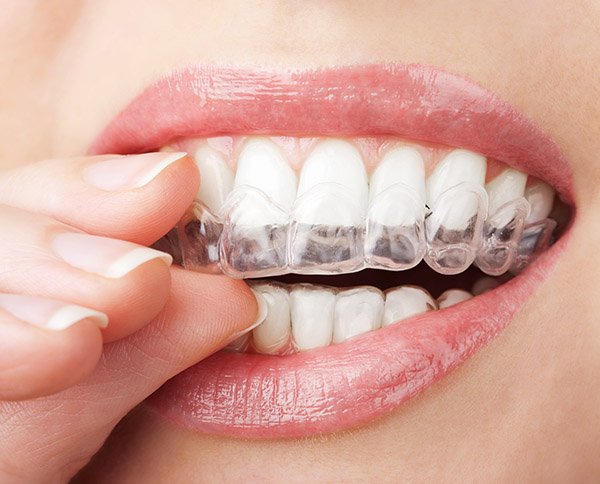 The Multiple Benefits Of Invisalign