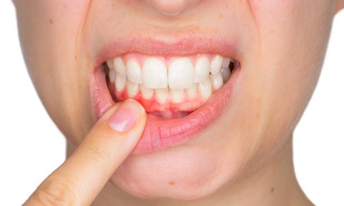 There Is Treatment For Your Receding Gumline