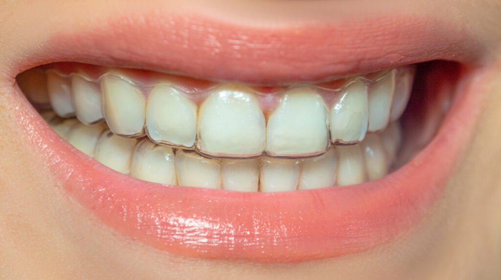 Invisalign in Fuquay Varina
