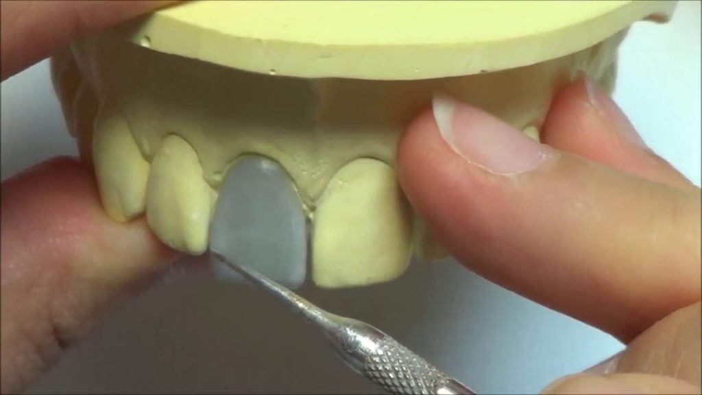 What Is Diagnostic Wax Up