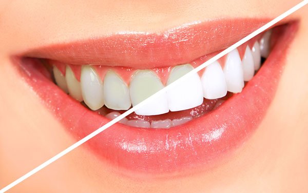 fuquay-varina-dentist-teeth-whitening