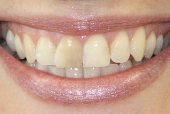 Whitening Single Dark Tooth